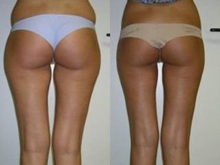 Liposuzione prima e dopo