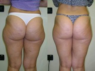 Cellulite prima e dopo