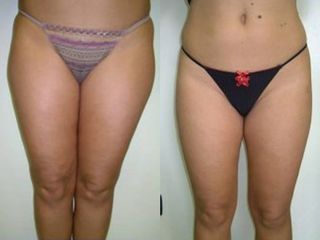 Liposuzione prima e dopo