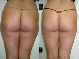 Liposcultura prima e dopo