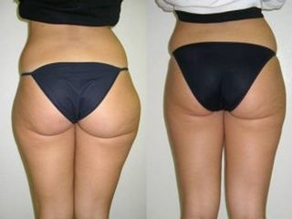 Liposcultura prima e dopo