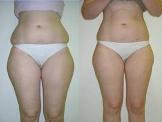 Liposuzione prima e dopo