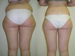 Liposuzione prima e dopo