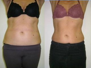 Liposcultura prima e dopo