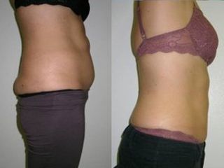 Liposcultura prima e dopo