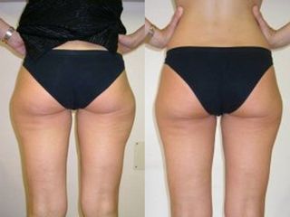 Liposuzione prima e dopo