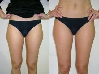 Liposuzione prima e dopo