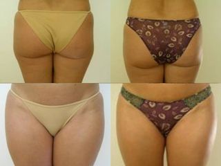 Liposcultura prima e dopo