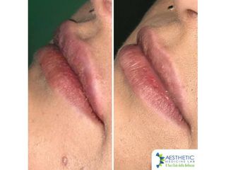 Filler labbra prima e dopo
