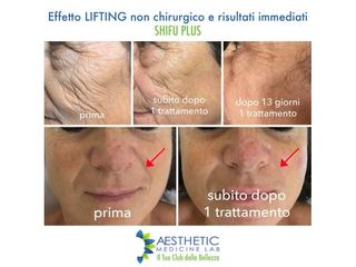 Lifting viso prima e dopo