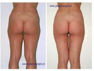 Liposcultura prima e dopo