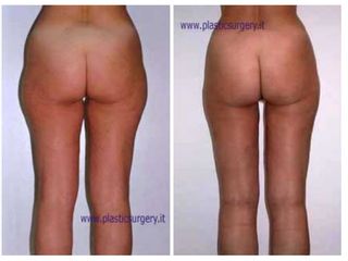 Liposcultura prima e dopo
