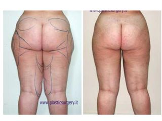 Liposcultura prima e dopo
