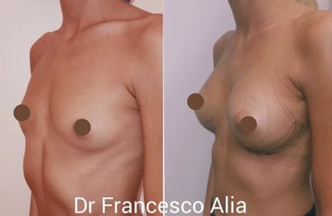 Mastoplastica additiva - Dott. Francesco Alia