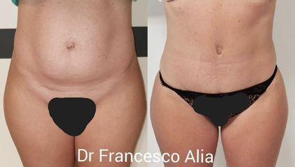 Liposuzione - Dott. Francesco Alia