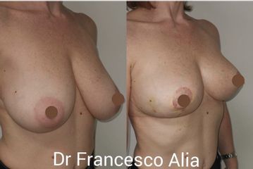 Mastoplastica riduttiva - Dott. Francesco Alia