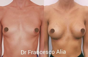 Mastoplastica additiva - Dott. Francesco Alia