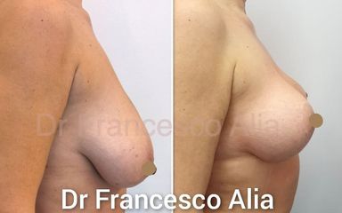 mastopessi Dott. Francesco Alia 