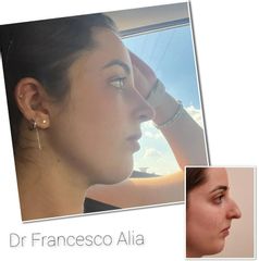 rinoplastica Dott. Francesco Alia 