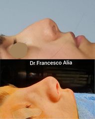 rinoplastica Dott. Francesco Alia