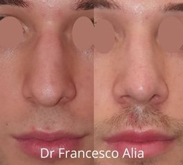 rinoplastica Dott. Francesco Alia 