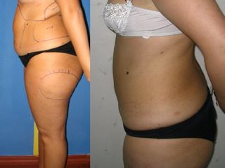 Liposcultura prima e dopo