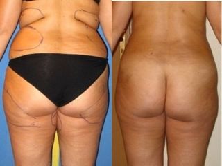 Liposcultura prima e dopo