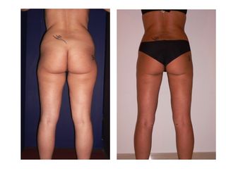 Lipoplastica ultrasonica prima e dopo