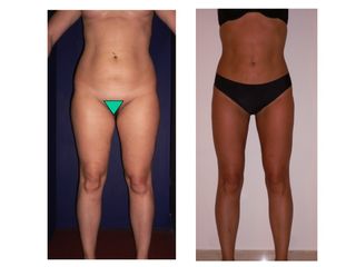 Lipoplastica ultrasonica prima e dopo