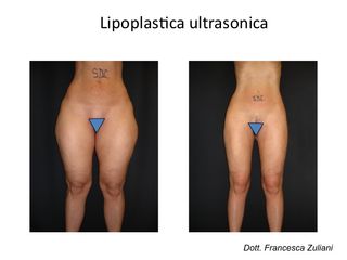 Lipoplastica ultrasonica prima e dopo