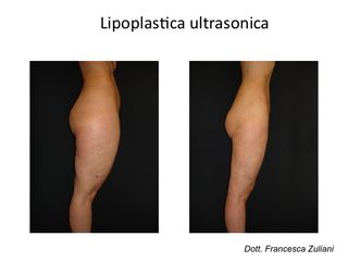 Lipoplastica ultrasonica prima e dopo