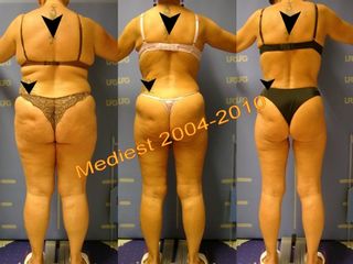Lipoplastica ultrasonica prima e dopo