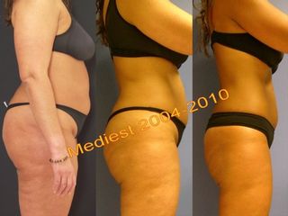 Lipoplastica ultrasonica prima e dopo
