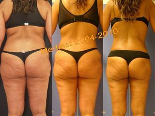 Lipoplastica ultrasonica prima e dopo