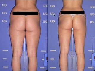 Lipoplastica ultrasonica prima e dopo