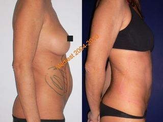 Lipoplastica ultrasonica prima e dopo