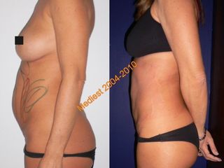 Lipoplastica ultrasonica prima e dopo