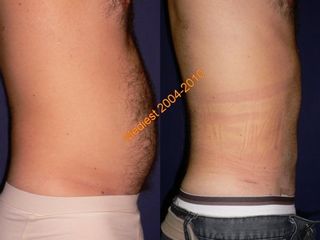 Lipoplastica ultrasonica prima e dopo