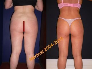 Lipoplastica ultrasonica prima e dopo