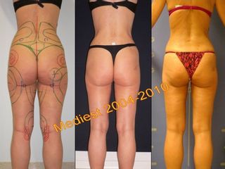 Lipoplastica ultrasonica prima e dopo