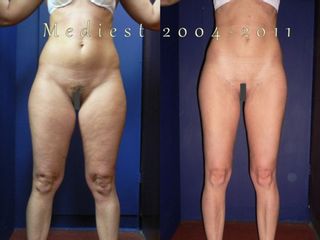 Lipoplastica ultrasonica prima e dopo