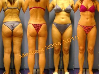 Lipoplastica ultrasonica prima e dopo