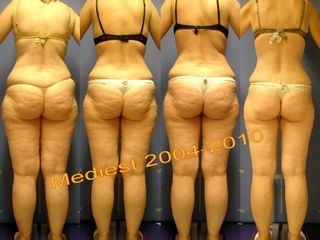 Lipoplastica ultrasonica prima e dopo