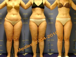 Lipoplastica ultrasonica prima e dopo