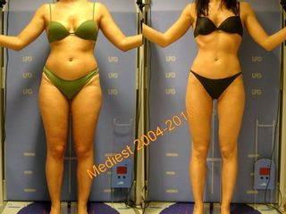 Lipoplastica ultrasonica prima e dopo