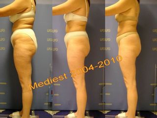 Lipoplastica ultrasonica prima e dopo