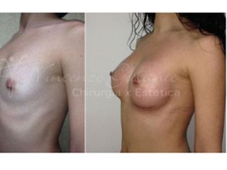 mastoplastica additiva prima dopo