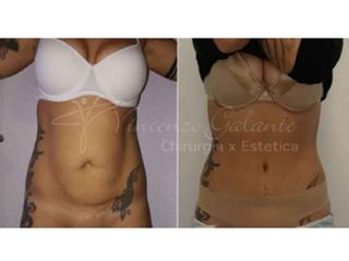 lipoaddominoplastica prima dopo