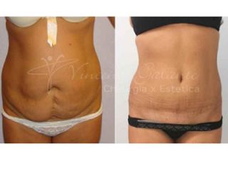 lipoaddominoplastica prima dopo