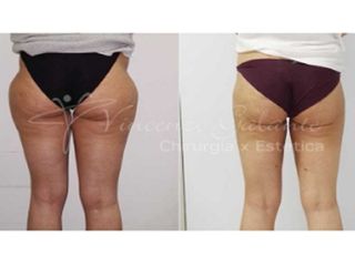 liposcultura prima dopo